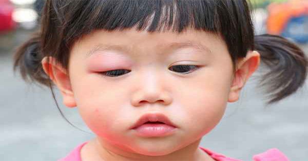 น่ารู้ ! โรคภูมิแพ้ขึ้นตาเด็ก จับสังเกตเมื่อลูกขยี้ตาบ่อย