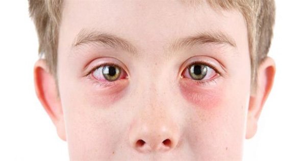 น่ารู้ ! โรคภูมิแพ้ขึ้นตาเด็ก จับสังเกตเมื่อลูกขยี้ตาบ่อย