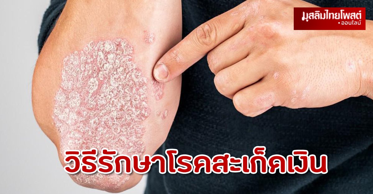 วิธีรักษาโรคสะเก็ดเงิน สมุนไพรไทยรักษาโรคสะเก็ดเงิน แนะนำหมอรักษาโรคสะเก็ดเงิน